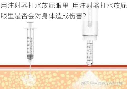 用注射器打水放屁眼里_用注射器打水放屁眼里是否会对身体造成伤害？